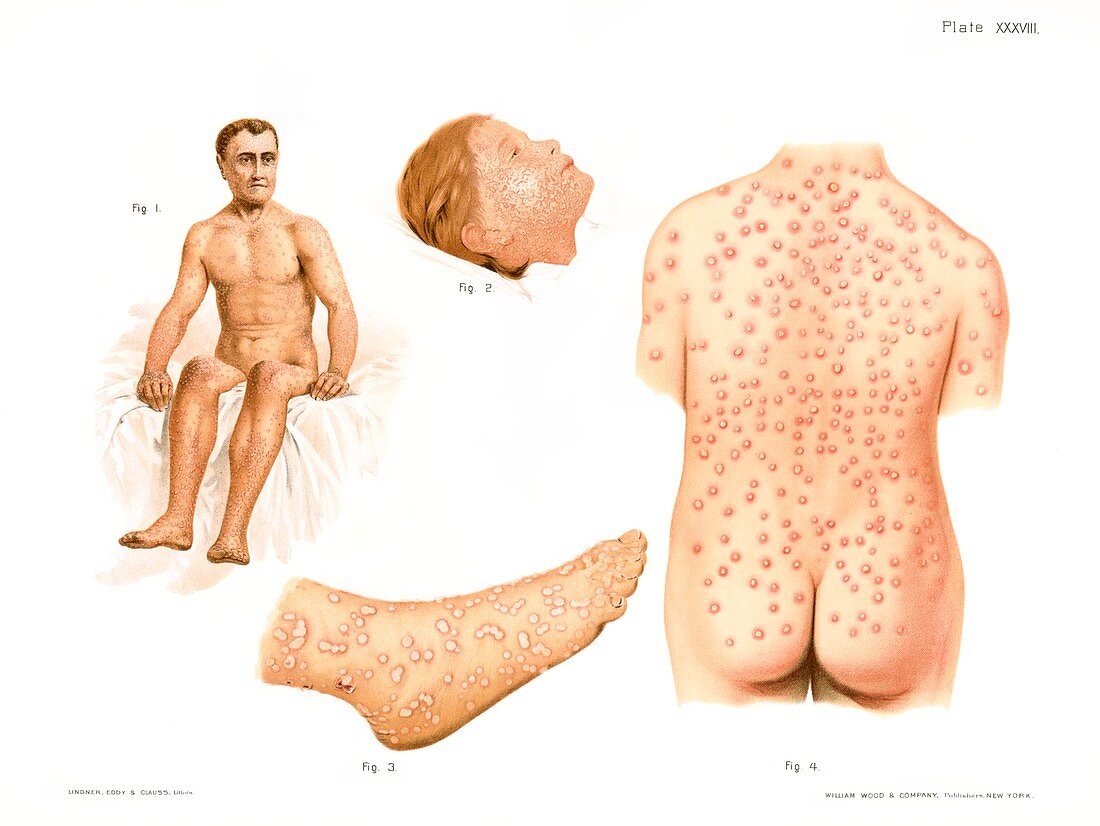 Smallpox and chicken pox, illustration