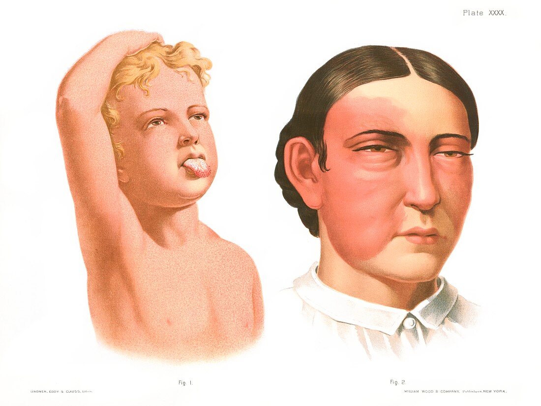 Scarlatina and erysipelas, illustration