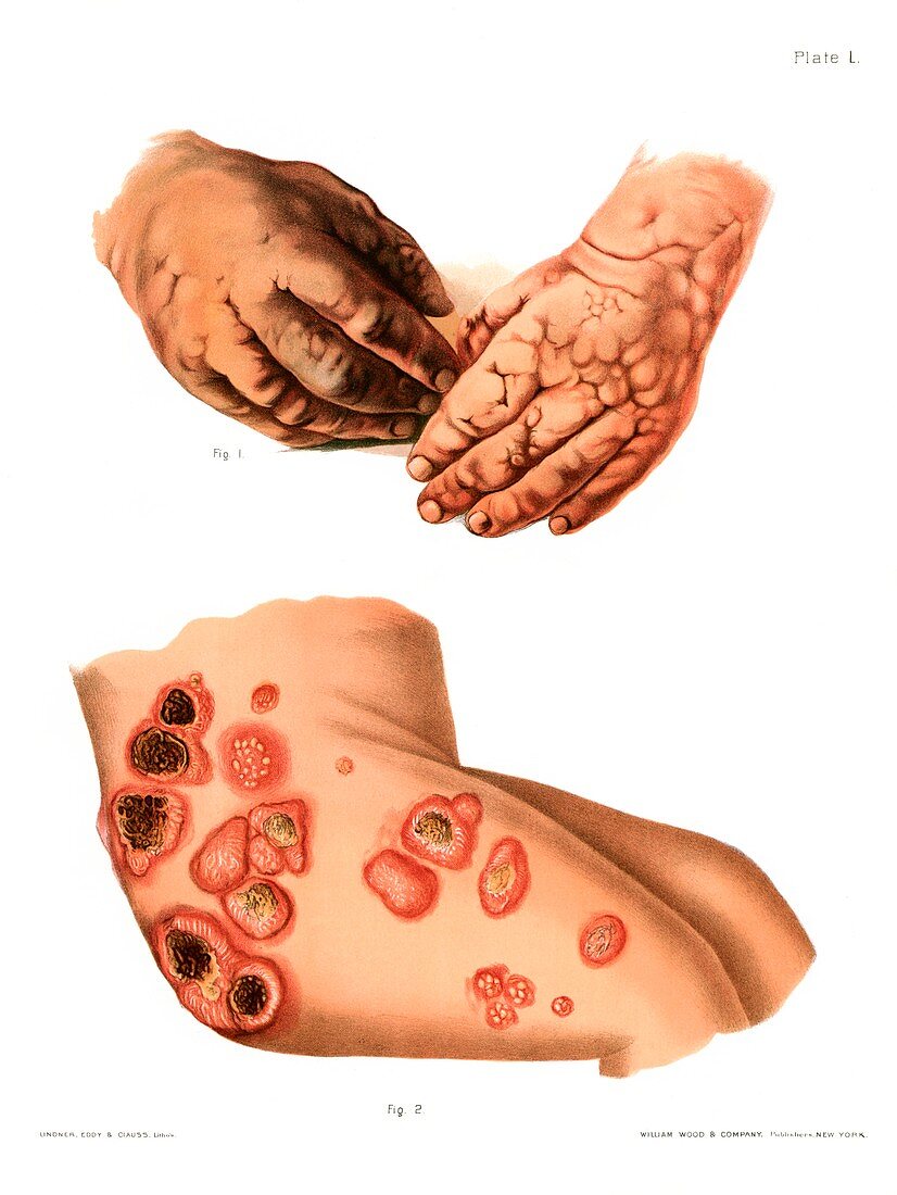 Adverse reactions to iodide drugs, illustration