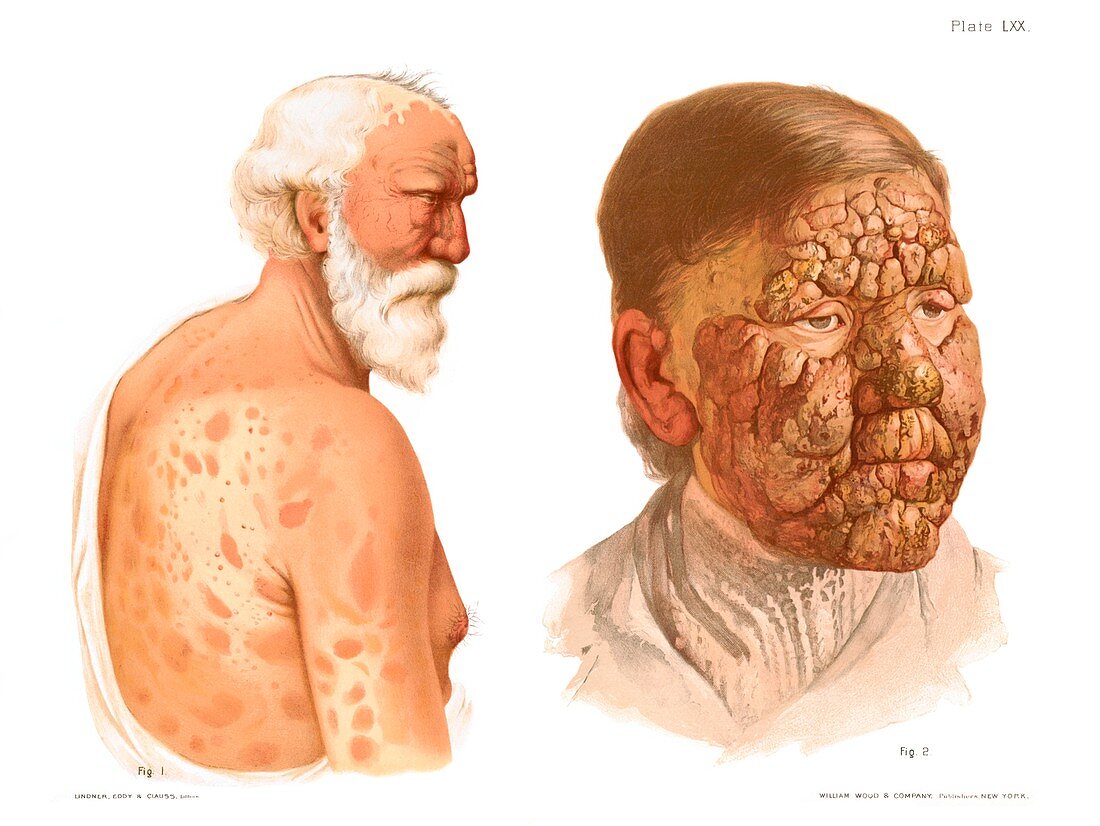 Leprosy, historical illustration