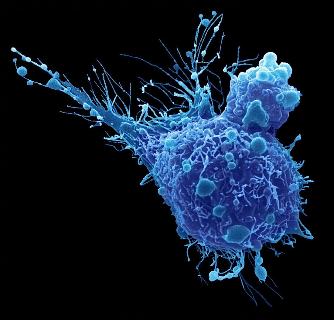 Bladder cancer cell, SEM
