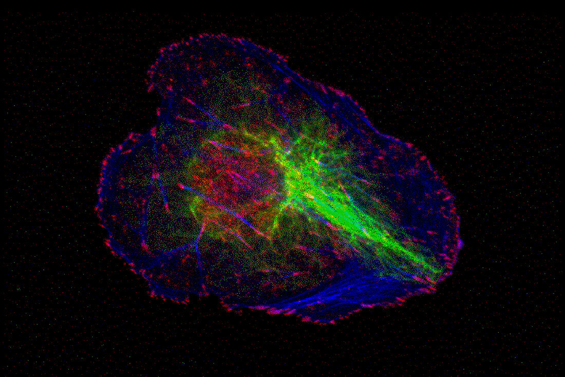 Breast tumour cell