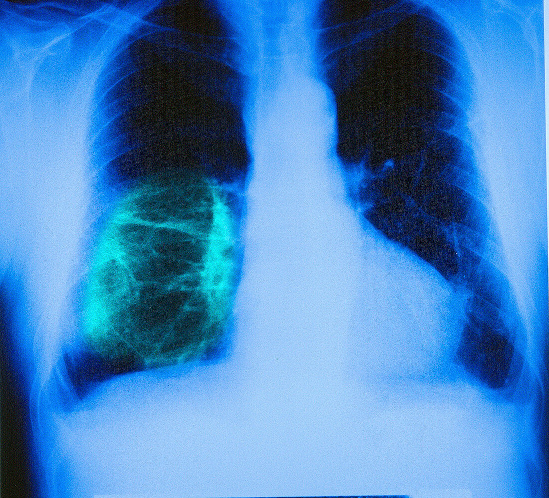 Asbestosis, x-ray