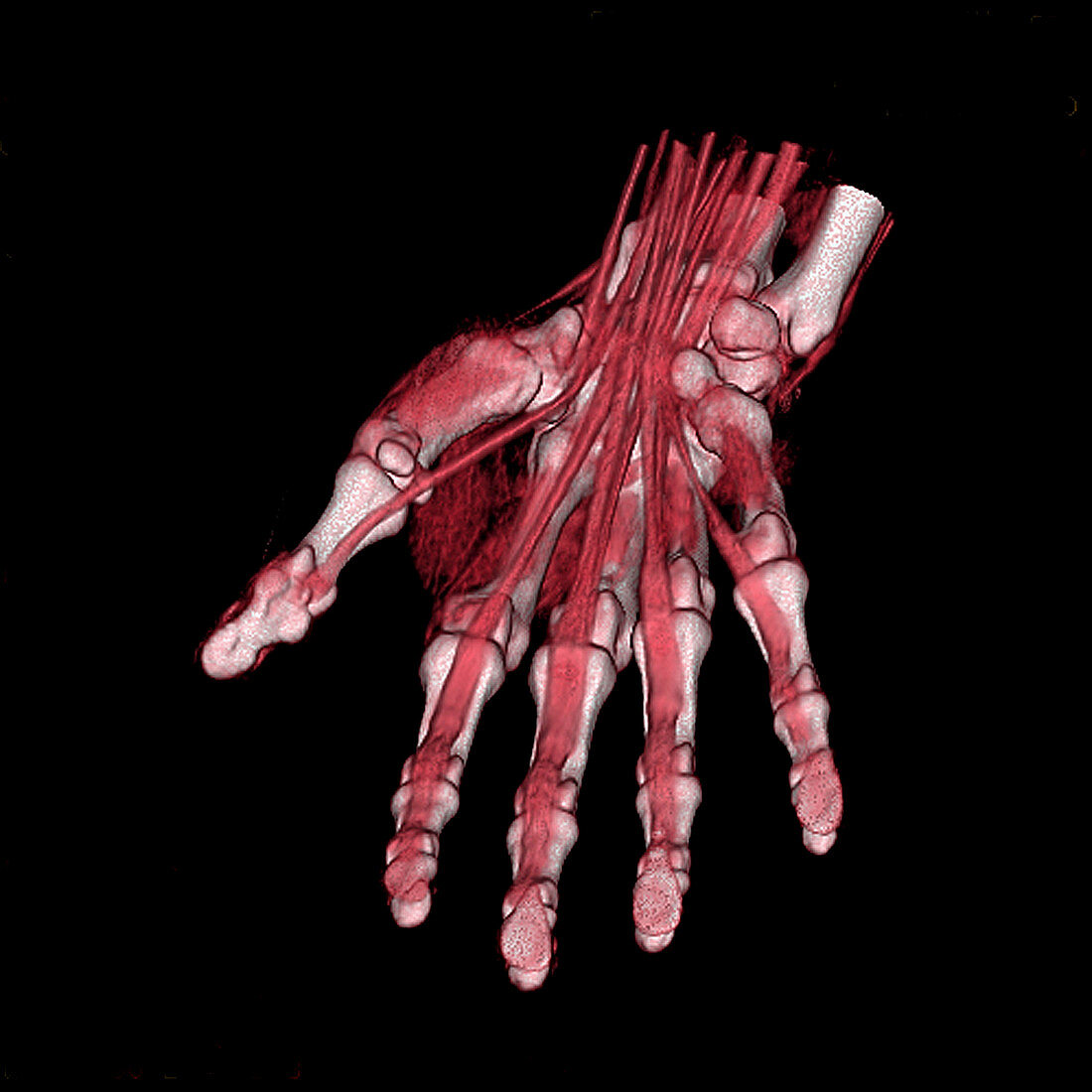 Hand, CT scan