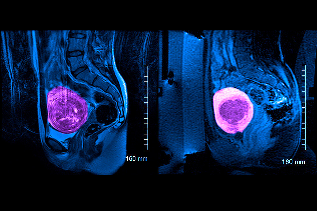 Uterine leiomyoma, MRI