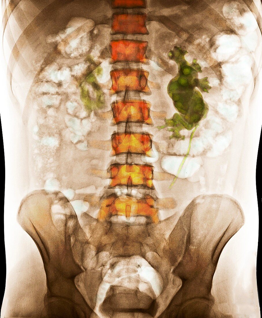 Dilated kidney, abdominal X-ray