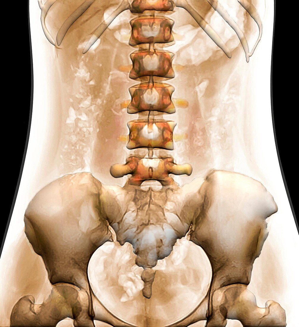 Spine and pelvis, 3D abdominal X-ray