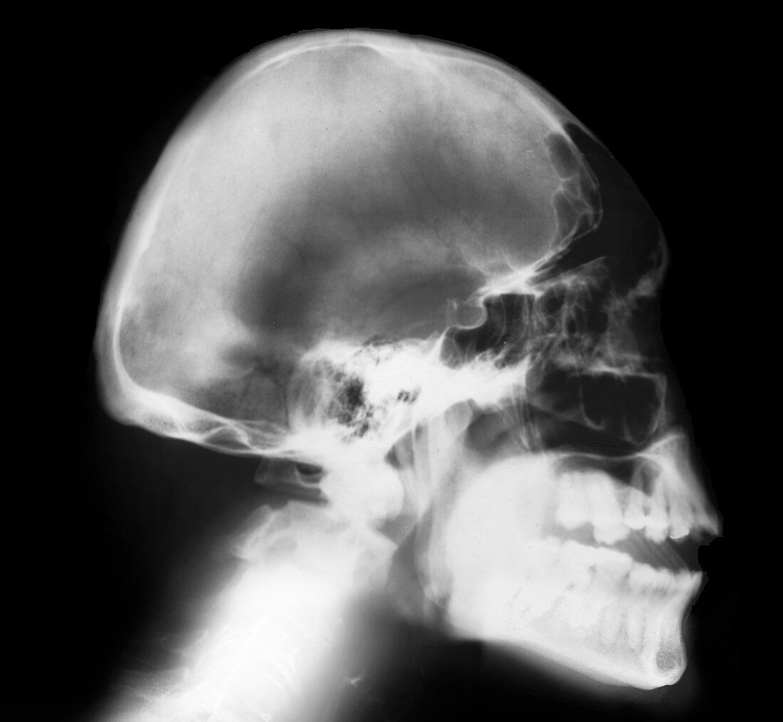 Microcephaly,X-ray