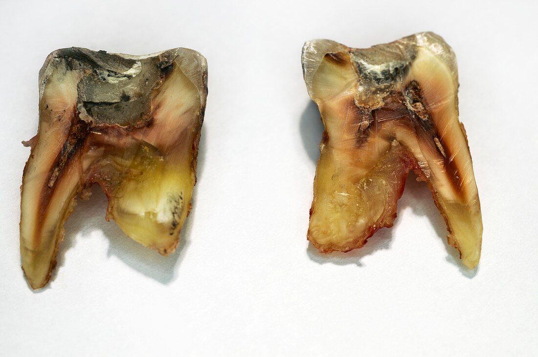 Extracted tooth structure
