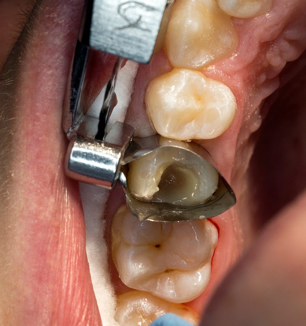 Dental filling cavity preparation