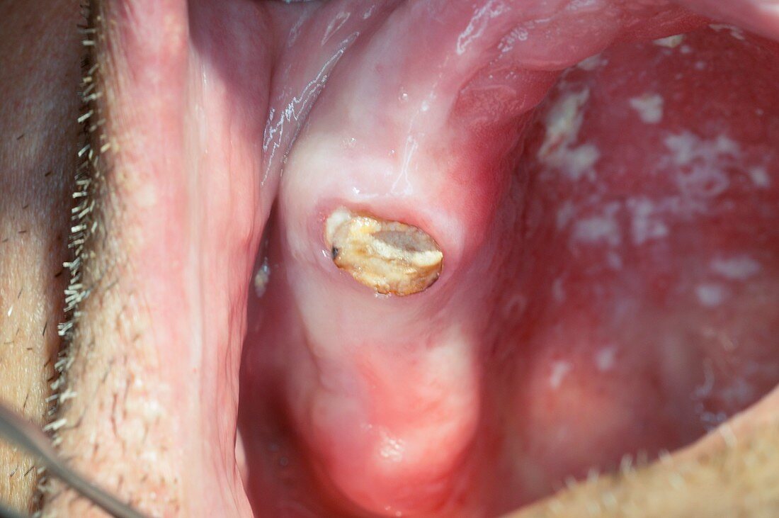 Decayed premolar tooth