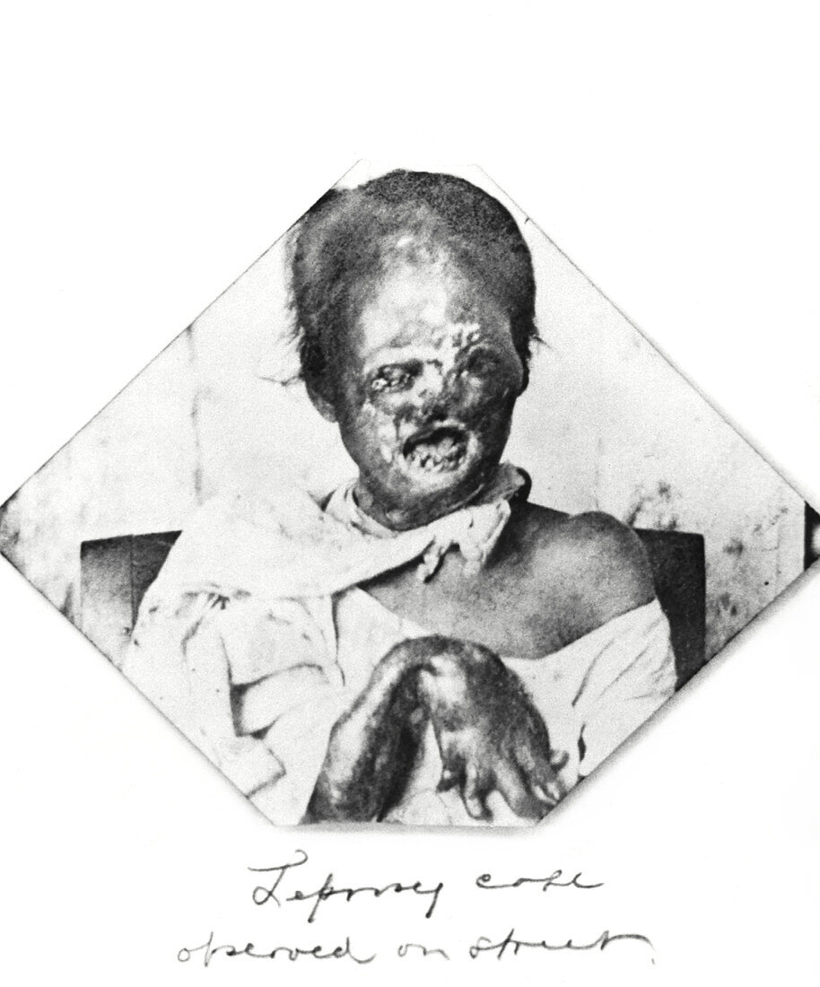 Leprosy patient,Philippines,1899