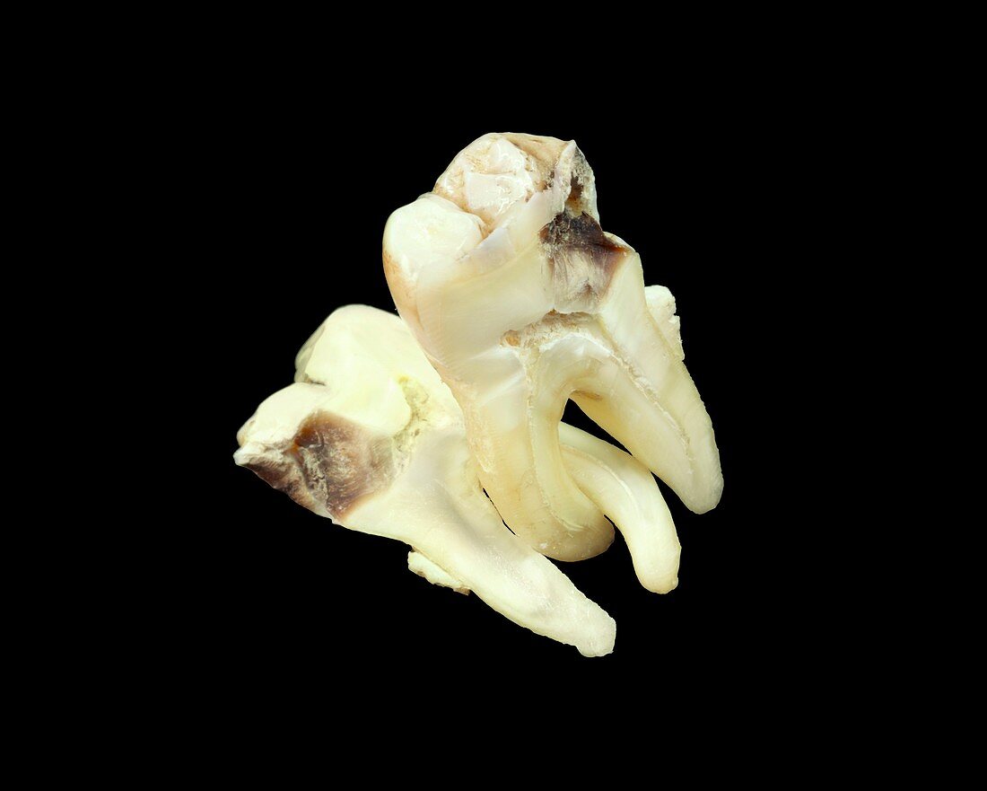 Decayed tooth structure