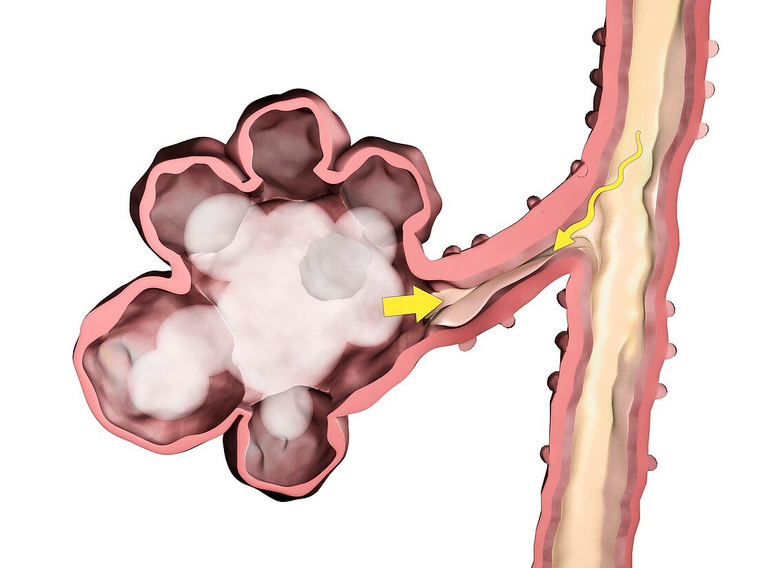 Alveoli in emphysema,illustration