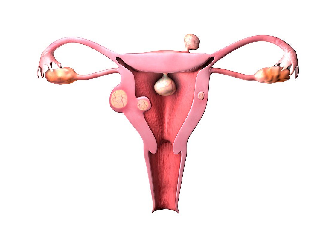 Uterine fibroids,illustration