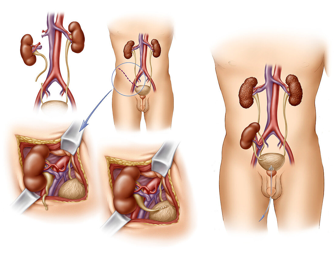 Kidney Transplant in Adult