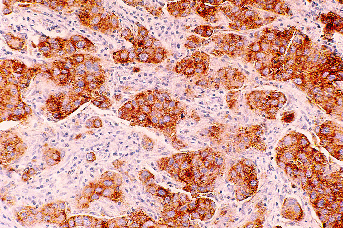 Ductal carcinoma of human breast
