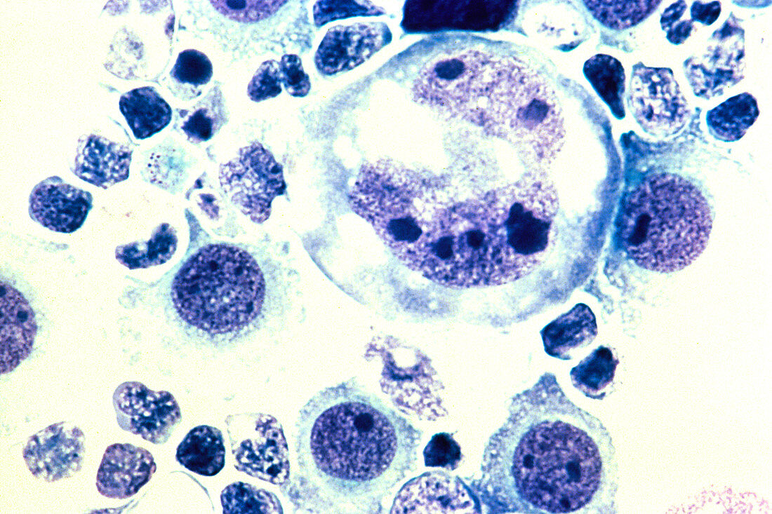 Lymphoma tumor cells