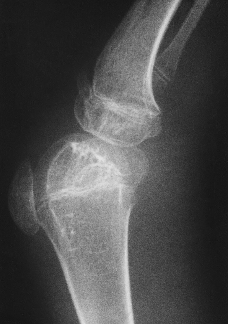 'Child's Knee,X-Ray'