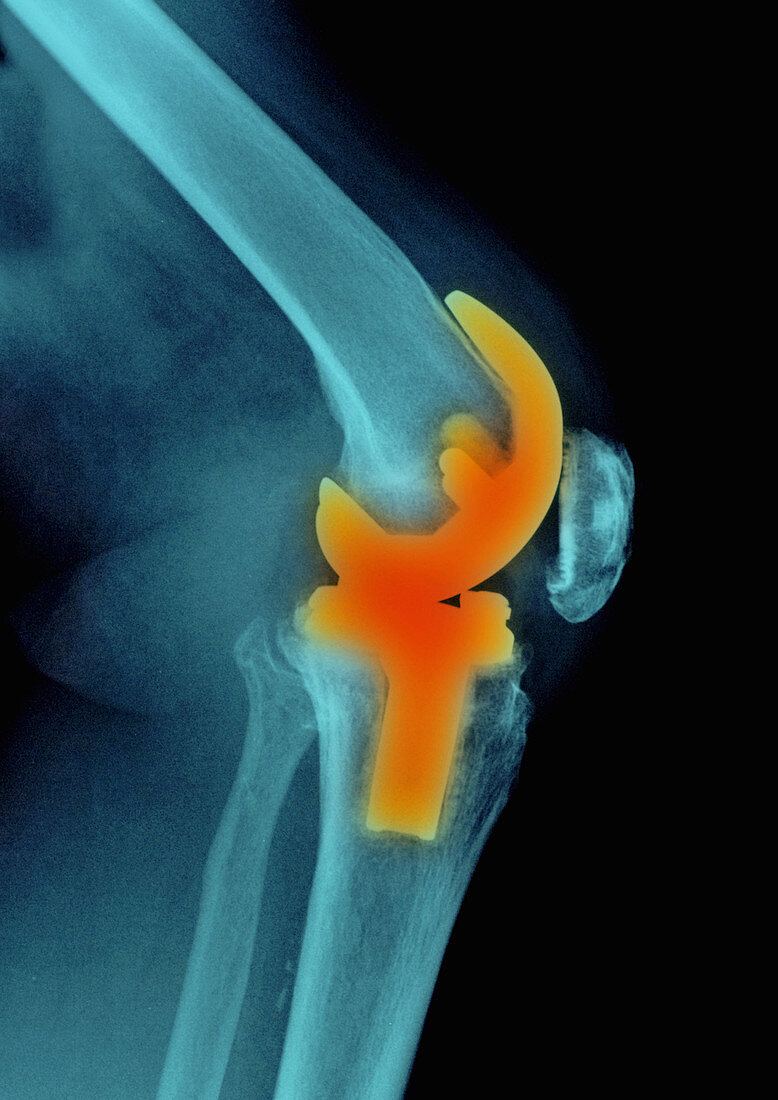 'Knee Replacement,X-ray'