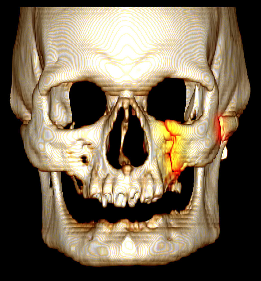 'Facial Fractures,CT Scan'