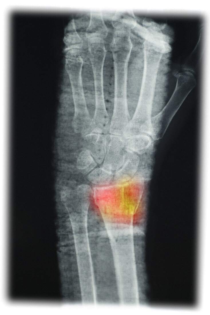 X-Ray of Wrist Fracture