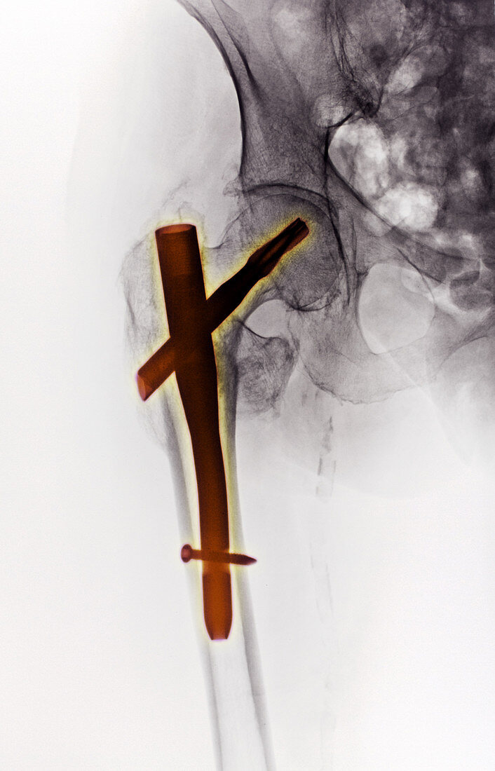 Hip Fracture with ORIF
