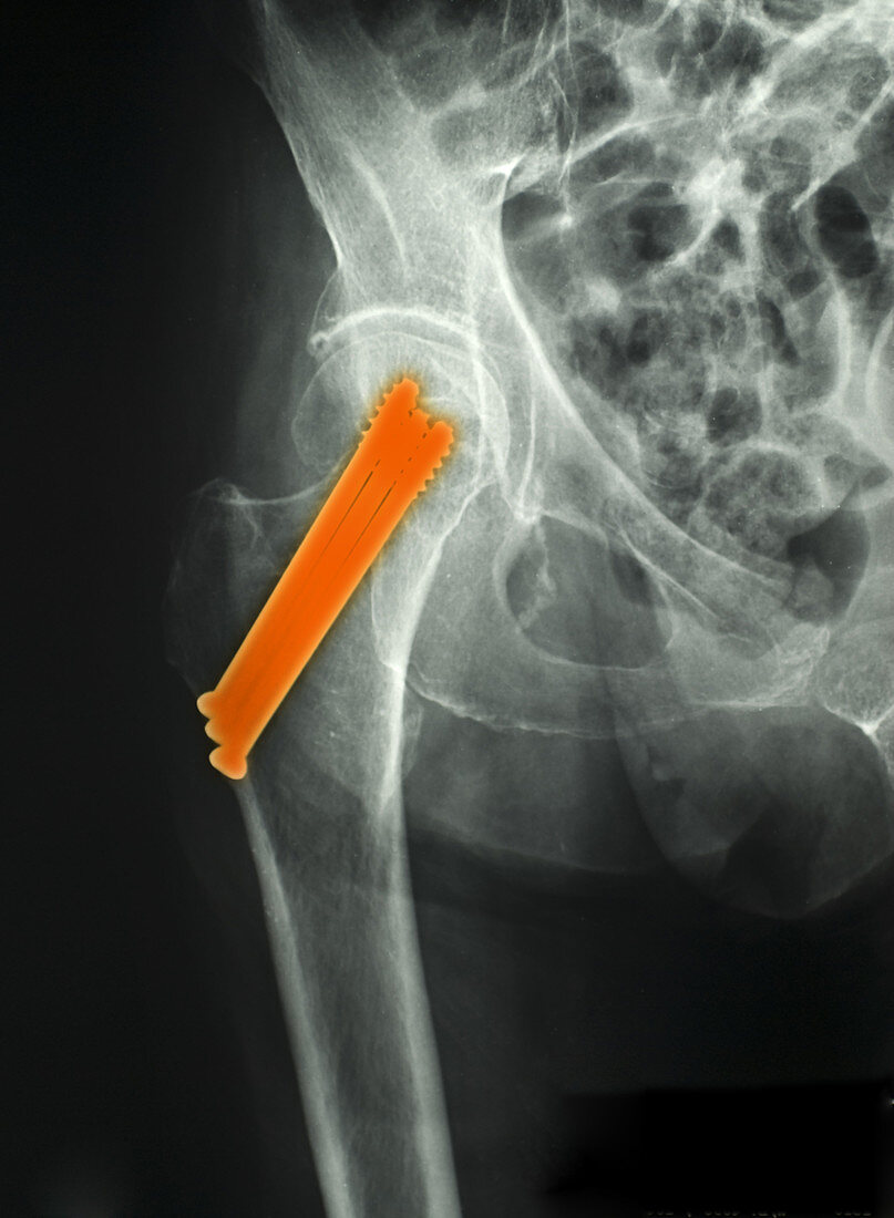 Hip Fracture with Screws