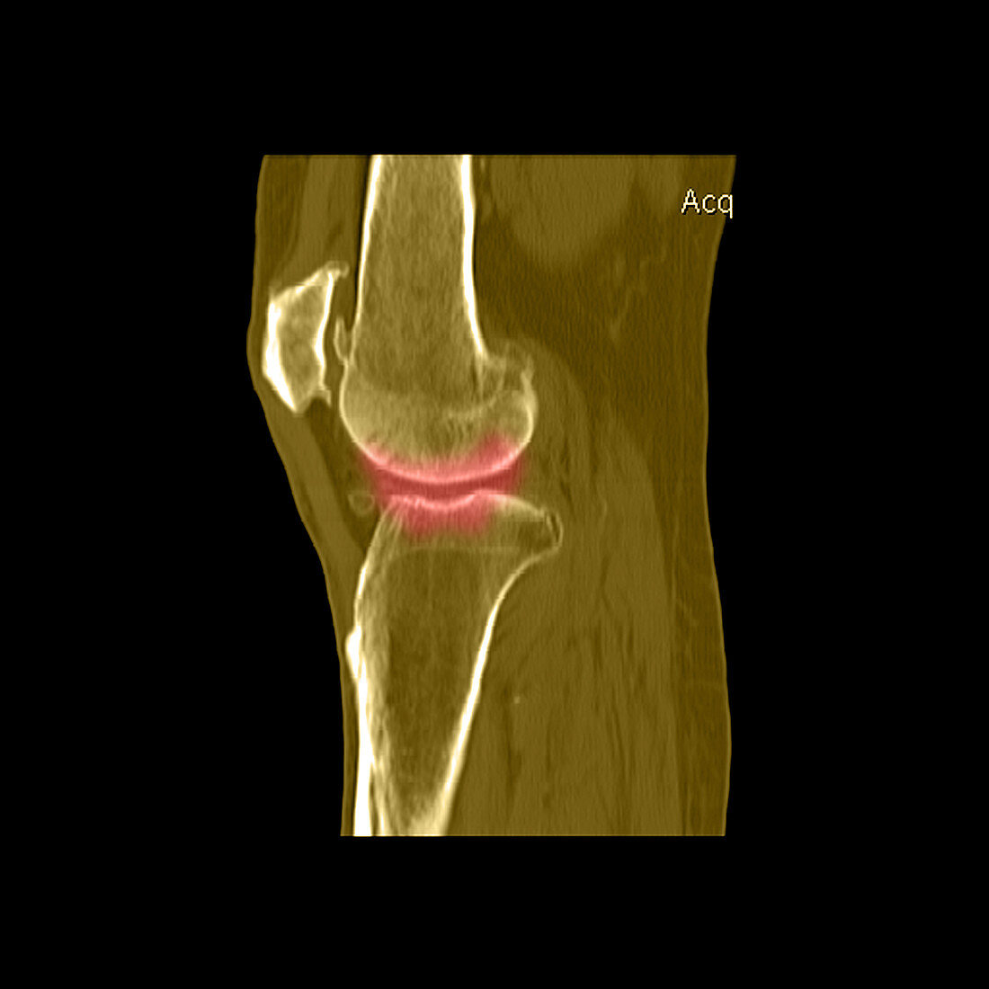 Knee Showing Osteoporosis