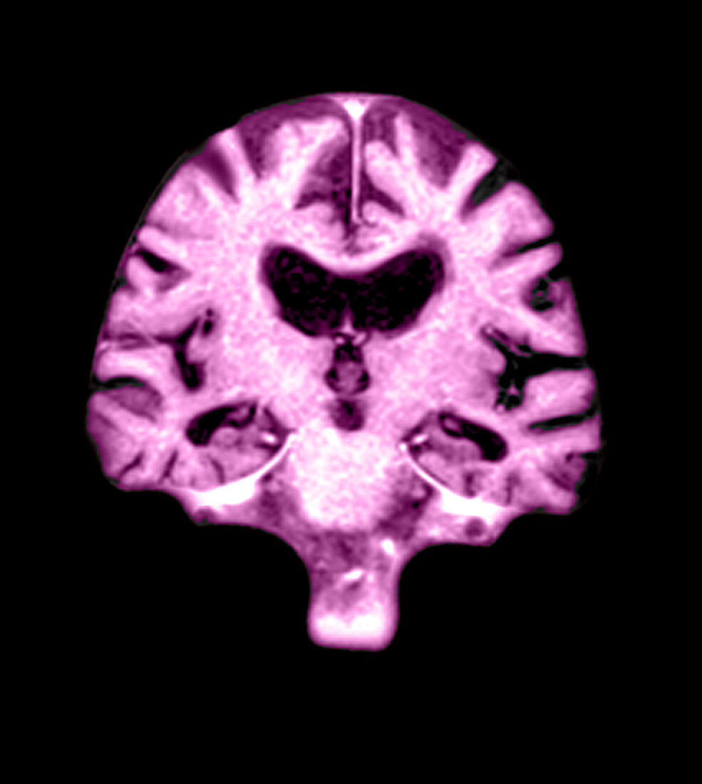 MRI of Brain With Alzheimer's Disease
