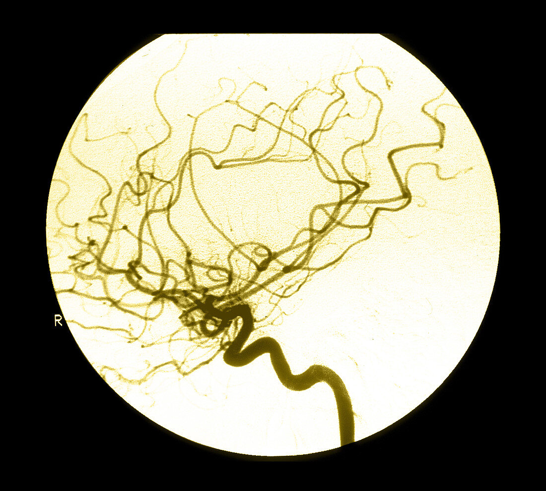 Internal Carotid Cerebral Angiogram