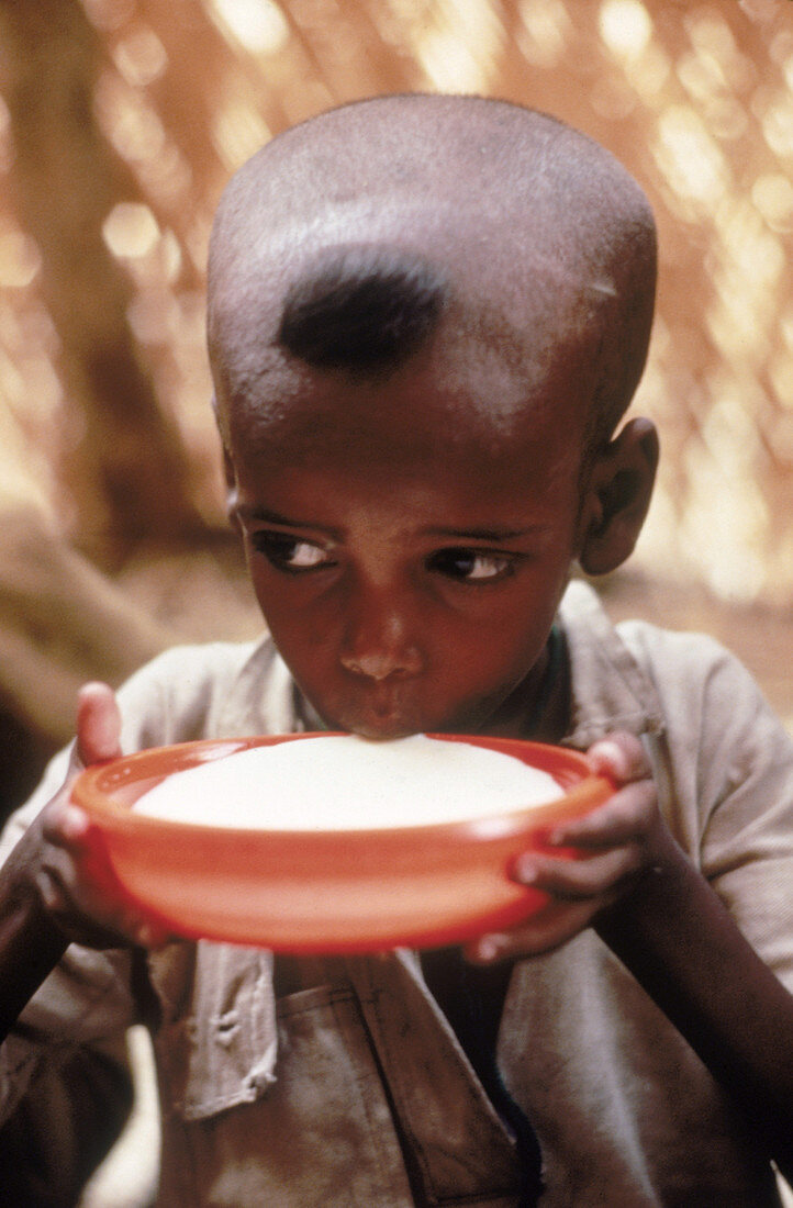 Malnourished child