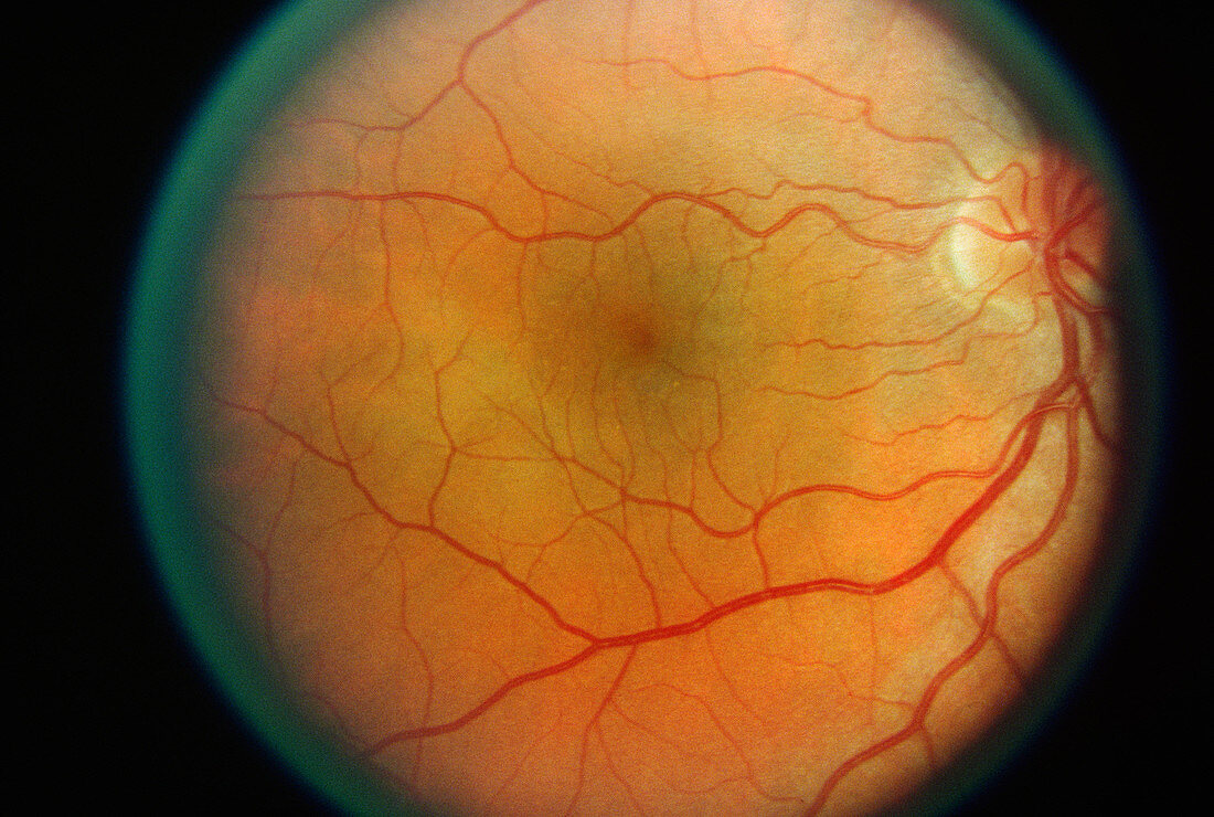 Normal Retina