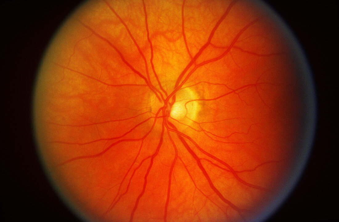 Hypertensive Retinopathy