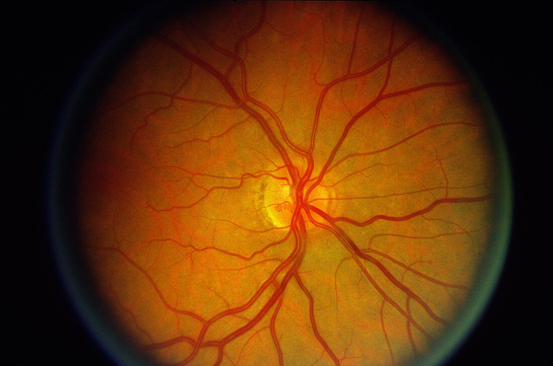 Diabetic Retinopathy