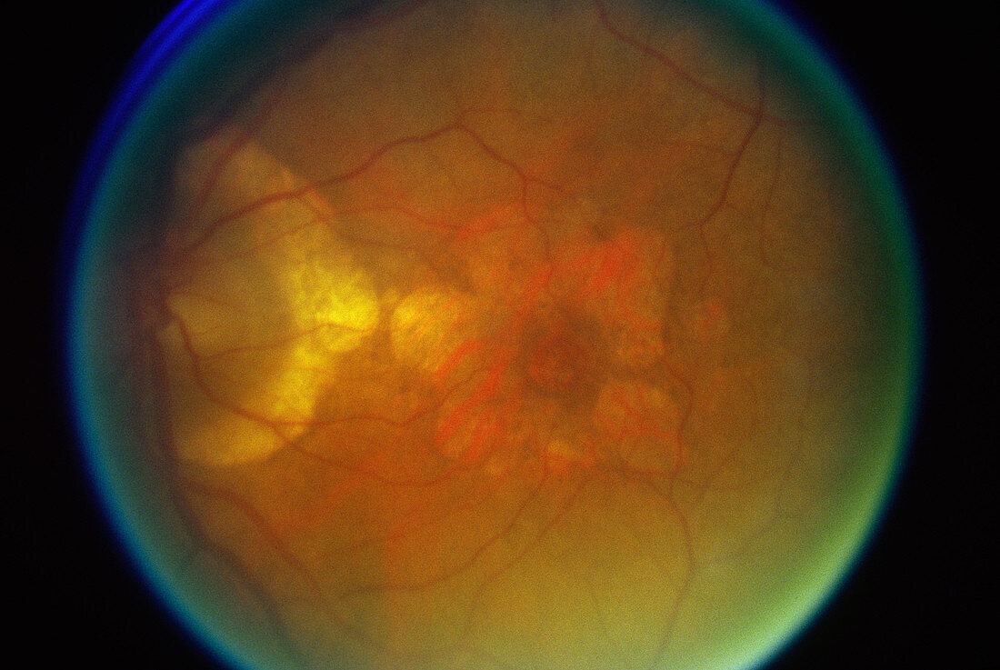 Graves' Ophthalmopathy