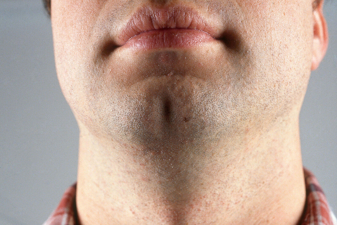 Cleft Chin