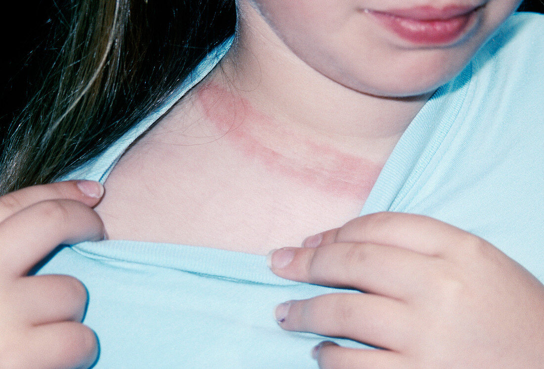 Lyme disease rash
