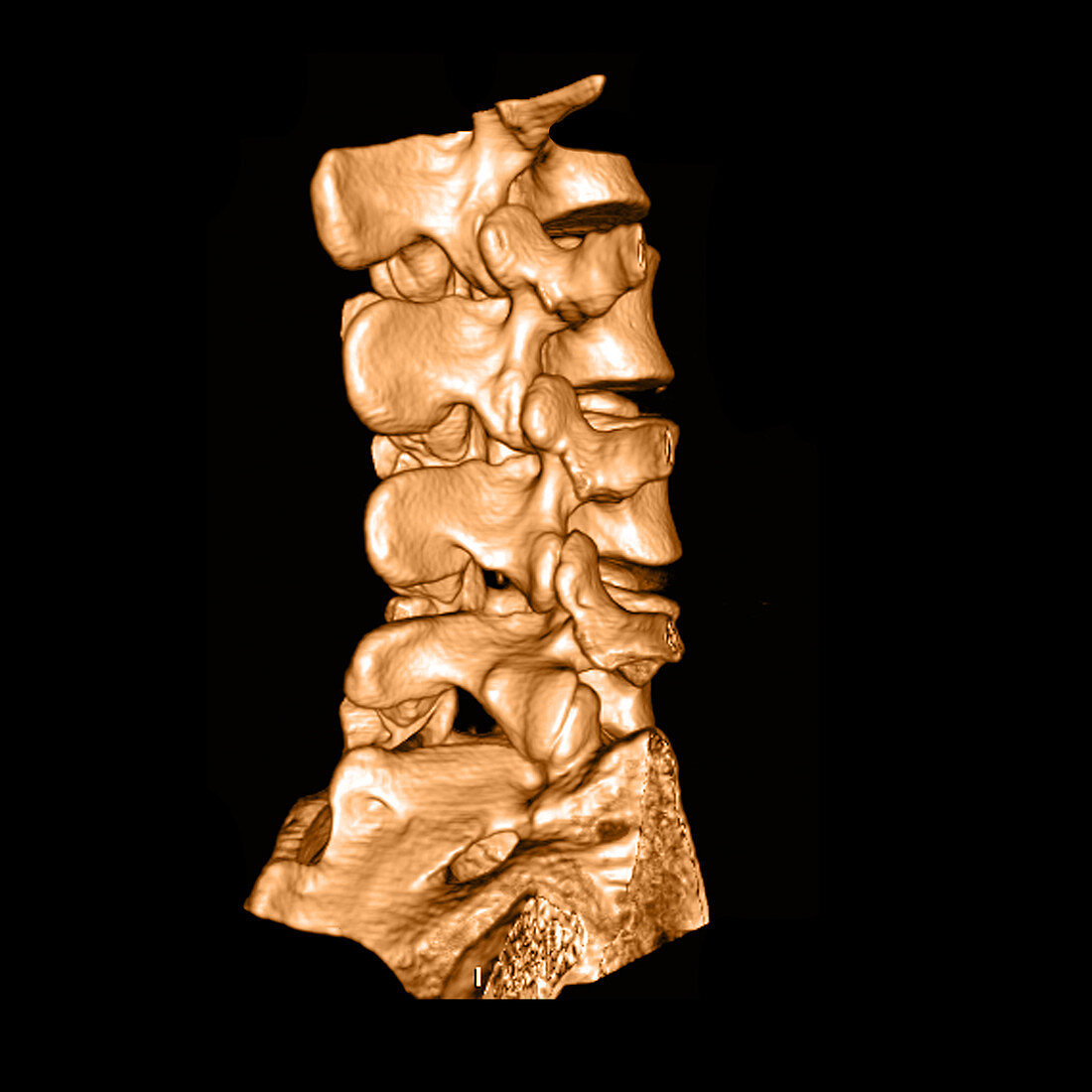 3D CT of Lumbar Spine