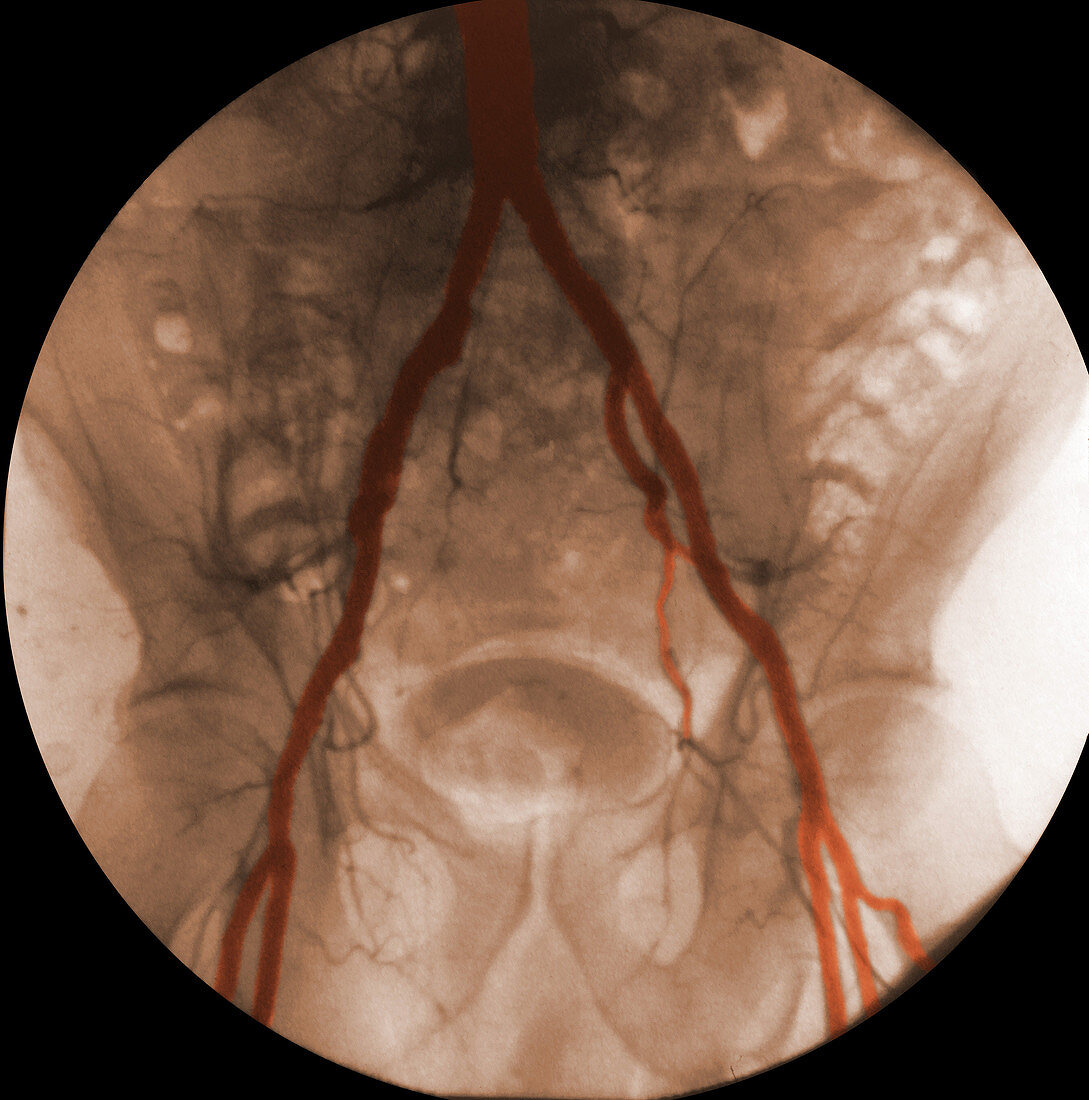 Angiogram of Iliac Arteries