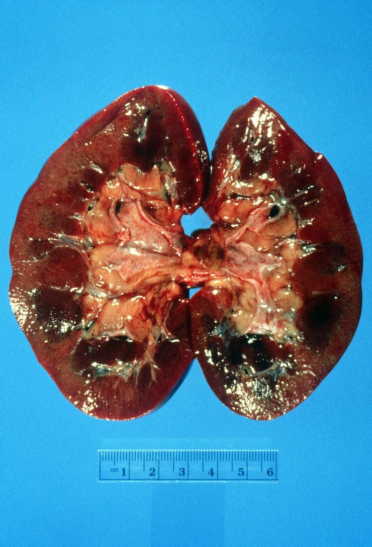Kidney Gross Specimen