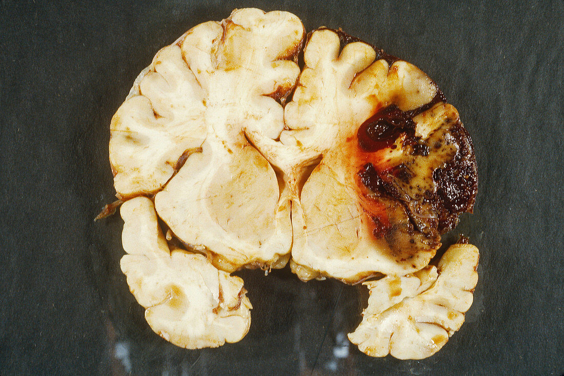 Cerebral hemorrhage