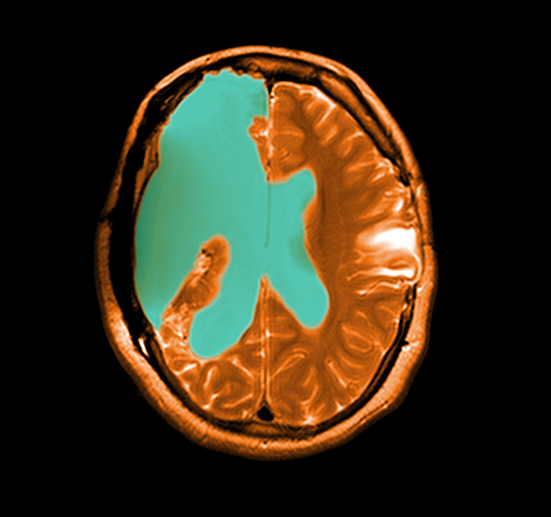 MRI shows near total hemispherectomy