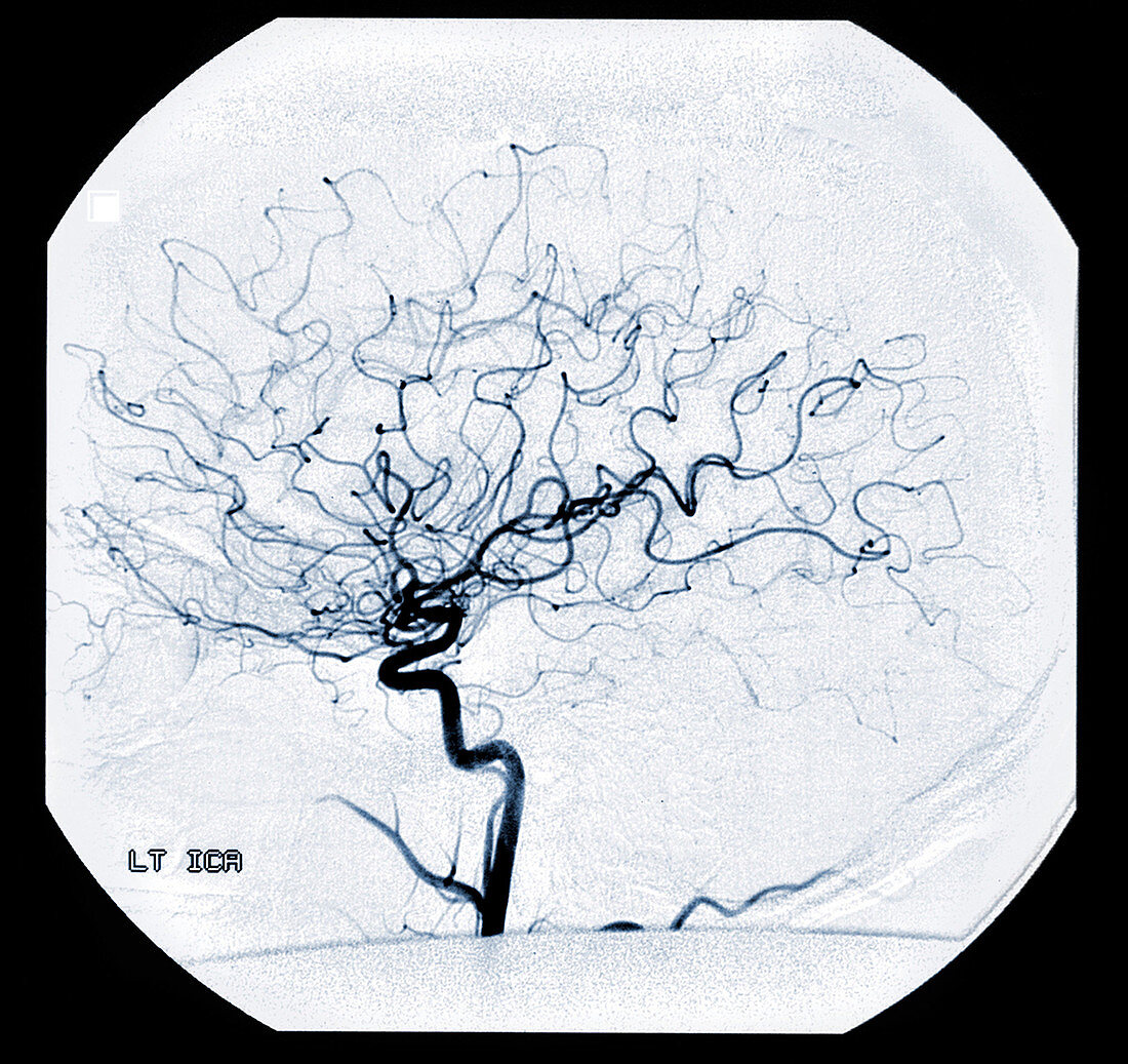 'Left Internal Carotid Artery,Angiogram'