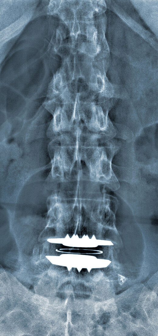 'Lumbar Vertebrae Arthroplasty,X-Ray'