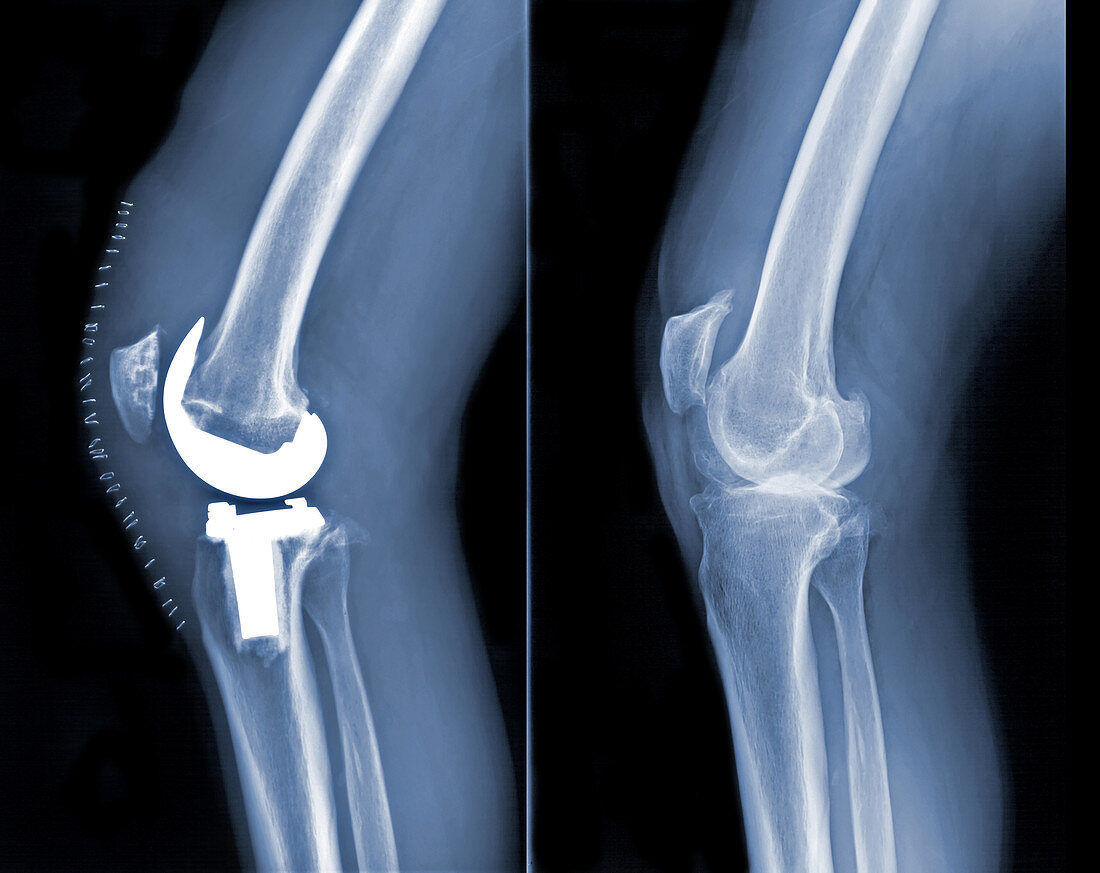 Bilateral Total Knee Replacement (Pre & P