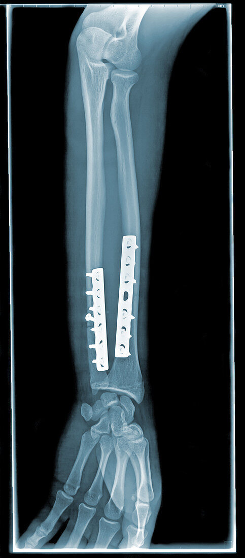 'Broken Wrist,X-Ray'