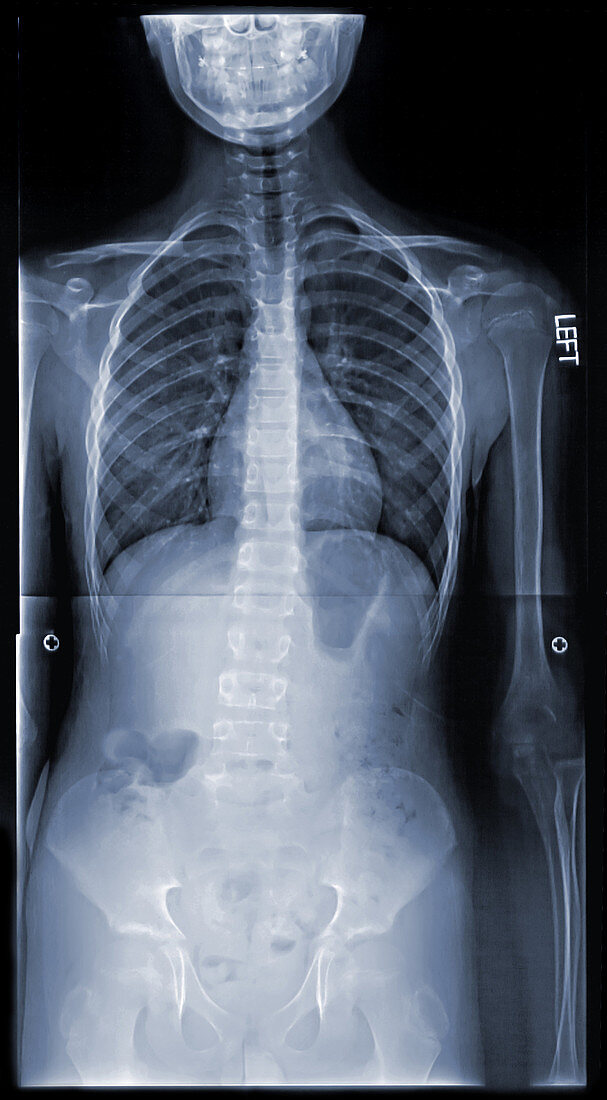 'Scoliosis,X-Ray'