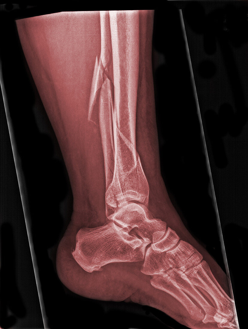 'Tibia-Fibula Fracture,X-Ray'