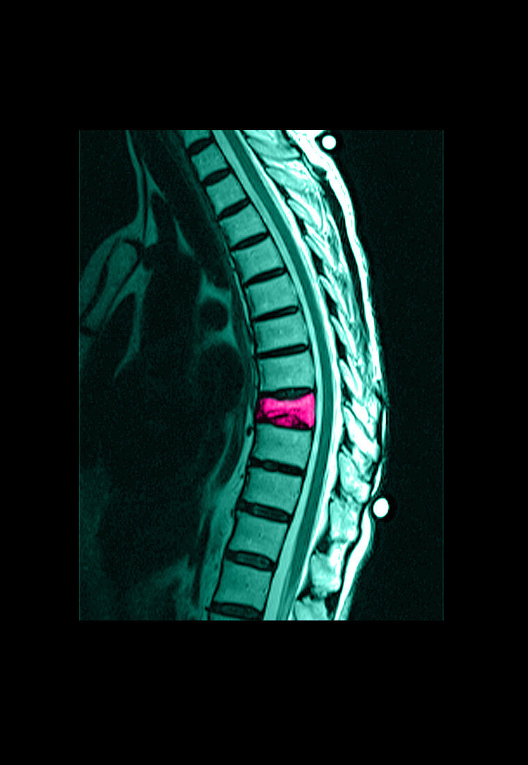 Spinal Compression Fracture